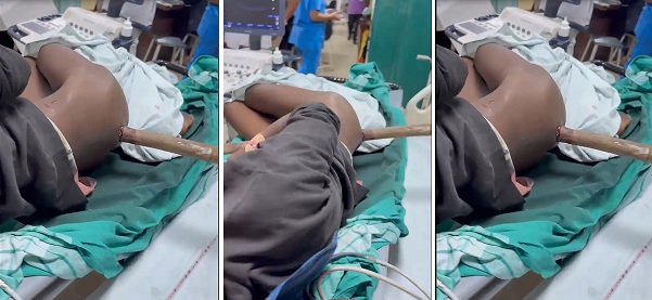 15 फीट लंबा बांस मजदूर के पेट में घुसा… डॉक्टरों ने OT में बुलाया कारपेंटर, देखें Video